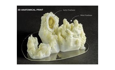 UR Medicine Heart Team Uses 3D Printing to Save Woman’s Life