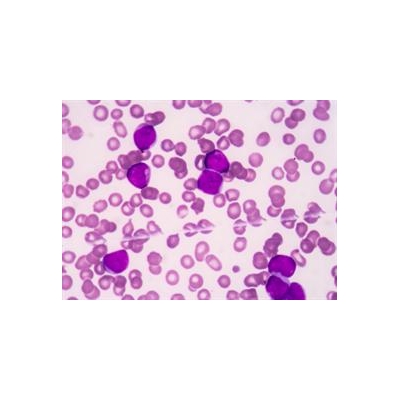 Wilmot Scientists Aim at a Genetically Lethal Strain of Leukemia