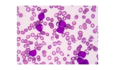 Wilmot Scientists Aim at a Genetically Lethal Strain of Leukemia