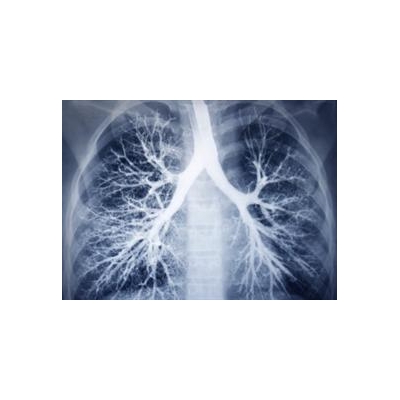 Combination Treatment for Fatal Lung Disease Shows Promise