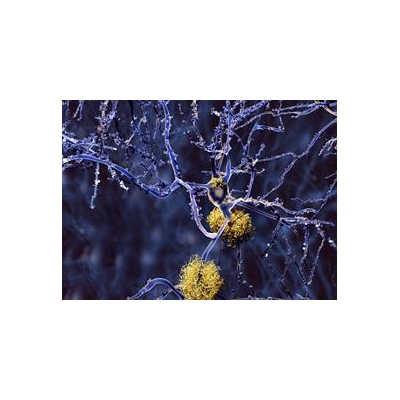 Study: Brain’s Immune System Could Be Harnessed to Fight Alzheimer’s