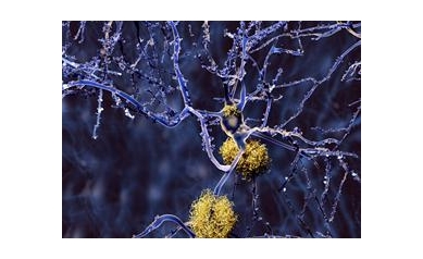 Study: Brain’s Immune System Could Be Harnessed to Fight Alzheimer’s