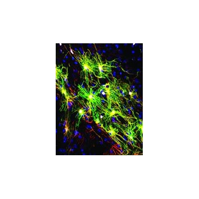Swapping Sick for Healthy Brain Cells Slows Huntington’s Disease