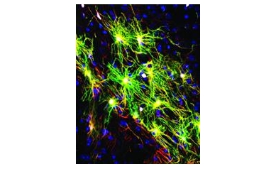 Swapping Sick for Healthy Brain Cells Slows Huntington’s Disease