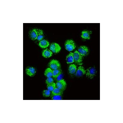 Drug Helps Reduce Involuntary Movements for People with Huntington Disease