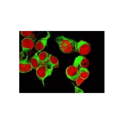 Nuclear Protein Causes Neuroblastoma to Become More Aggressive