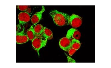 Nuclear Protein Causes Neuroblastoma to Become More Aggressive