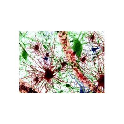 Research Will Explore New Therapies for Huntington’s Disease