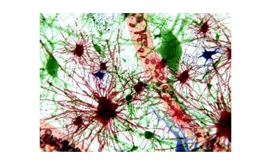 Research Will Explore New Therapies for Huntington’s Disease