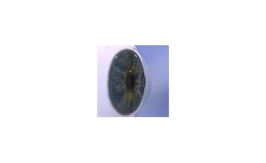 UR Medicine’s Flaum Eye Institute First in Region to Offer Procedure for Near Vision Loss