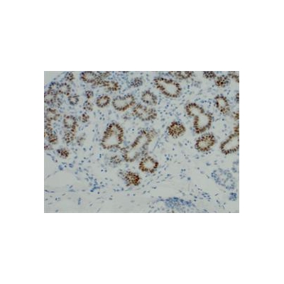 Are We on the Heels of a Gene Signature for High-Grade Breast Cancer?