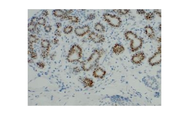 Are We on the Heels of a Gene Signature for High-Grade Breast Cancer?