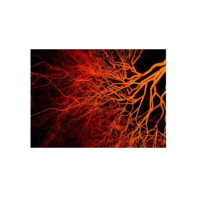 Study Will Explore Link Between HIV, Micro-Strokes, and Dementia