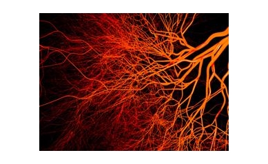 Study Will Explore Link Between HIV, Micro-Strokes, and Dementia