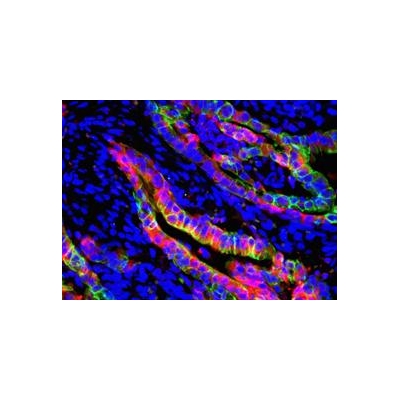 Pancreatic Tumors May Require a One-Two-Three Punch