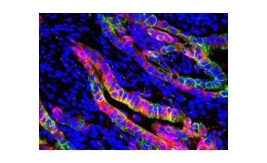 Pancreatic Tumors May Require a One-Two-Three Punch