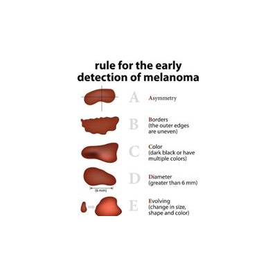 Research is Changing the Game for Melanoma Treatment
