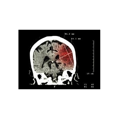 AHA Grants Will Accelerate Search for New Stroke Therapies