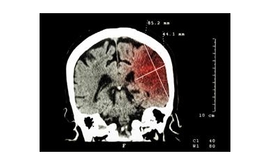 AHA Grants Will Accelerate Search for New Stroke Therapies