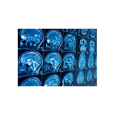 NIH Extends URMC’s Role in Network to Advance Neurological Care