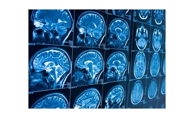NIH Extends URMC’s Role in Network to Advance Neurological Care