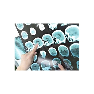 Drug Shows Promise in Slowing Multiple Sclerosis
