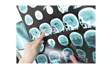 Drug Shows Promise in Slowing Multiple Sclerosis