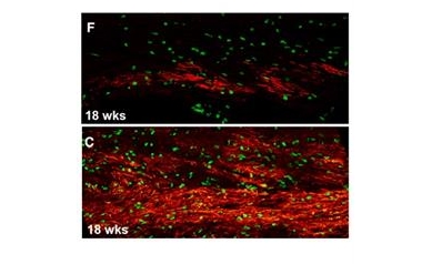 Study Confirms Central Role of Brain’s Support Cells in Huntington’s, Points to New Therapies