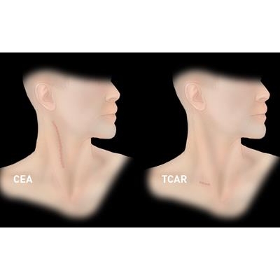 UR Medicine A Leader in Stroke Prevention with Less Invasive Technique