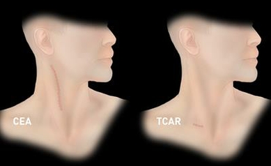 UR Medicine A Leader in Stroke Prevention with Less Invasive Technique