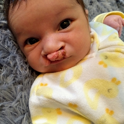 Drive By Dentistry During COVID 19 Helps Infant