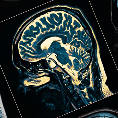 Copper Identified as Culprit in Alzheimer’s Disease