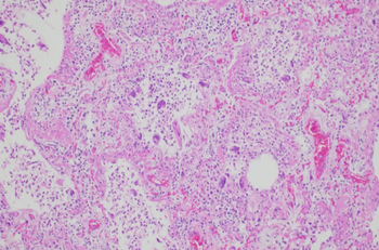 COVID Positive Lung