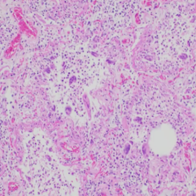 URMC Researchers Receive New Support to Study Effects of COVID-19 on Children and Adult Lungs