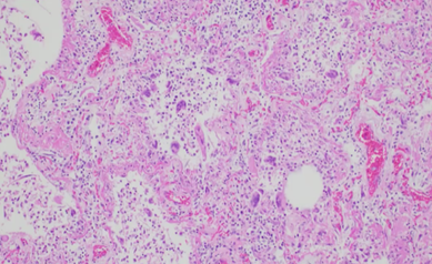 URMC Researchers Receive New Support to Study Effects of COVID-19 on Children and Adult Lungs
