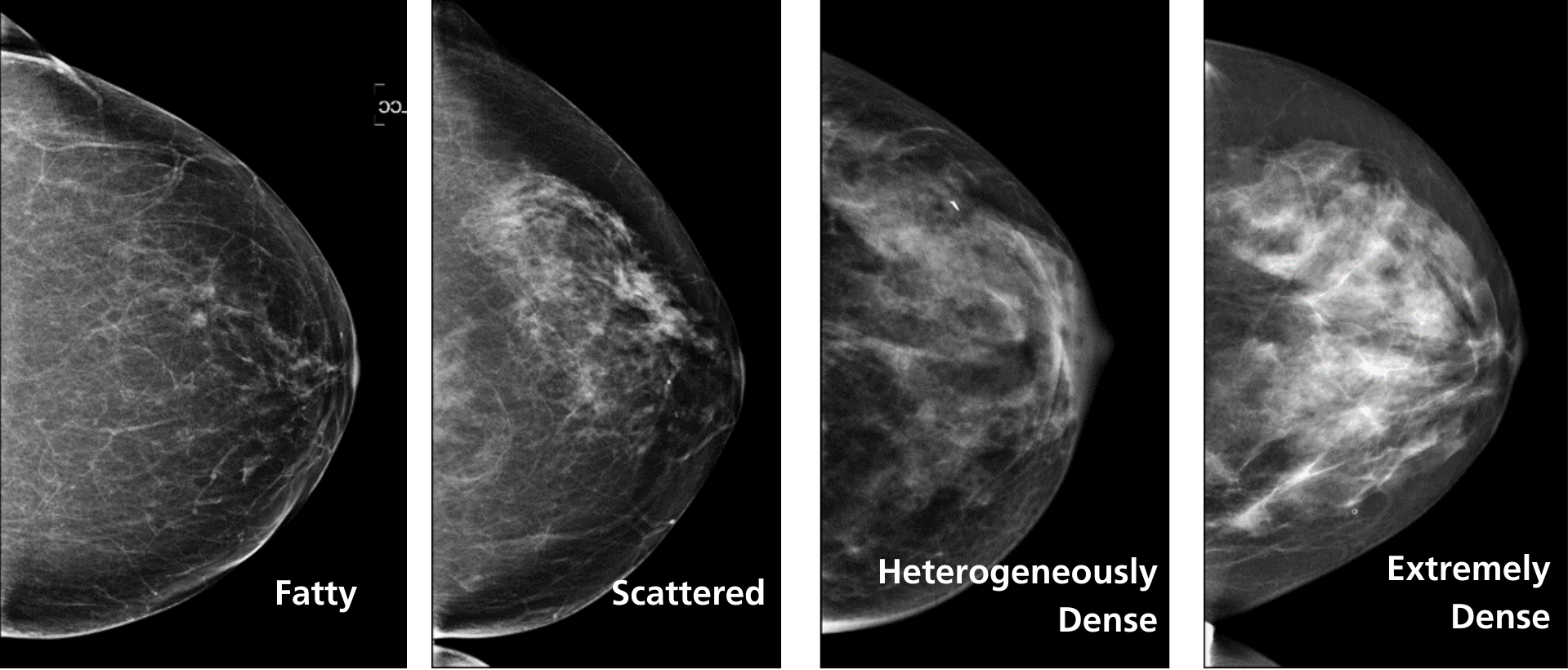 The four types of breast tissue, as seen on a mammogram