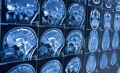 URMC to Launch New Brain Aging Research Center