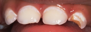 18month old cavities