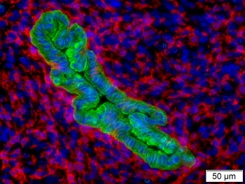 A scientific image of green cancer cells surrounded by red macrophages, forming a protective barrier around the cancer.
