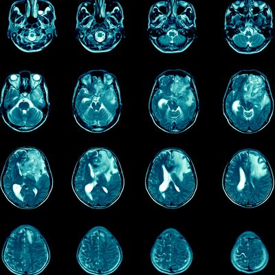 Magnetic resonance imaging Finding  5 cm isodense mass with ill-defined margin and surrounding edema at Left frontal lobe. Glioblastoma, brain metastasis.science and education mri brain background.