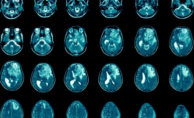 Magnetic resonance imaging Finding  5 cm isodense mass with ill-defined margin and surrounding edema at Left frontal lobe. Glioblastoma, brain metastasis.science and education mri brain background.