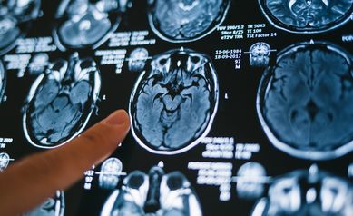 Current Guidance May Unnecessarily Delay Care for Stroke Victims