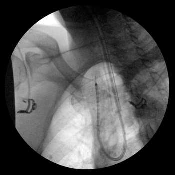 Catheter tight turn