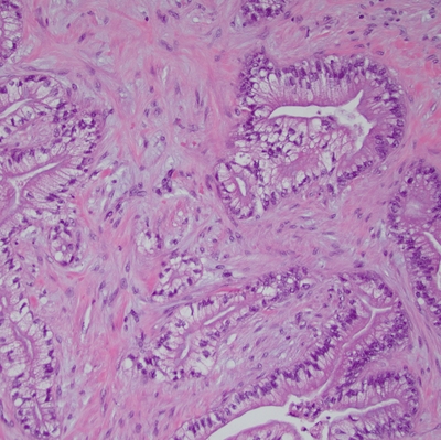 PDAC 20x - pancreatic cancer 2 - from URMC pathology - Nov 2023