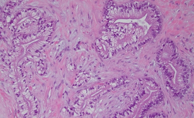 PDAC 20x - pancreatic cancer 2 - from URMC pathology - Nov 2023