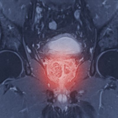 Interdisciplinary Approach Provides Best Possible Care for Patients with Prostate Cancer