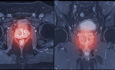 Interdisciplinary Approach Provides Best Possible Care for Patients with Prostate Cancer