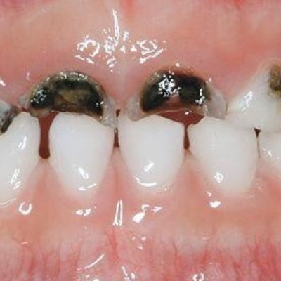 Early Childhood Caries Severe