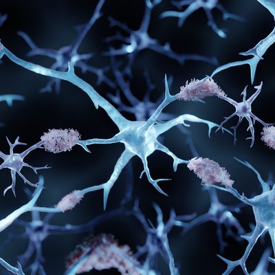 A chance observation finds potential hearing biomarker for Alzheimer’s disease