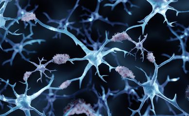 A chance observation finds potential hearing biomarker for Alzheimer’s disease